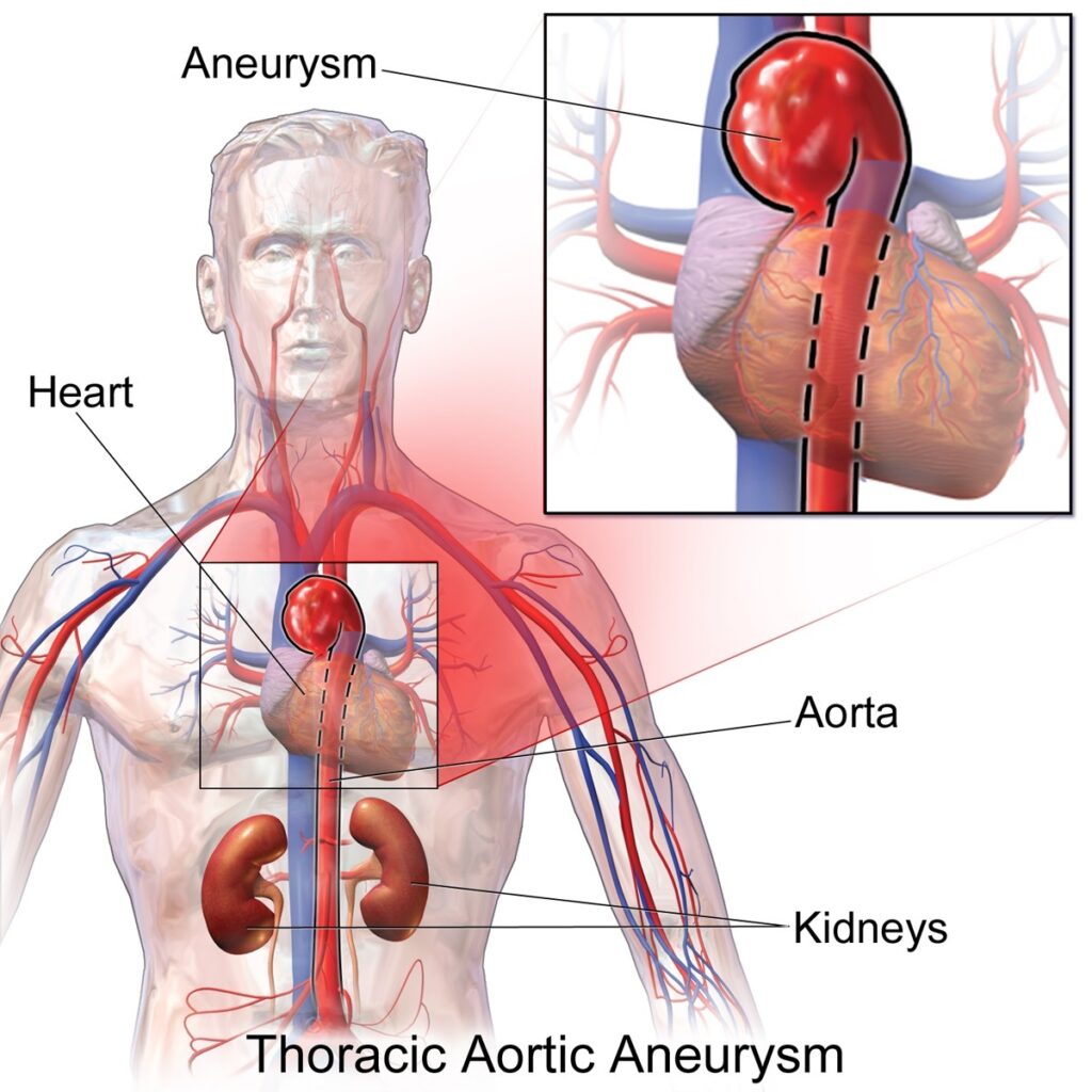 Phình động mạch chủ ở tim là căn bệnh nguy hiểm gây ra cơn đau ở ngực 