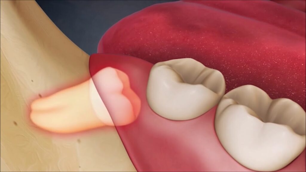 Răng khôn khi mọc lệch gây đau đớn nguyên hàm 
