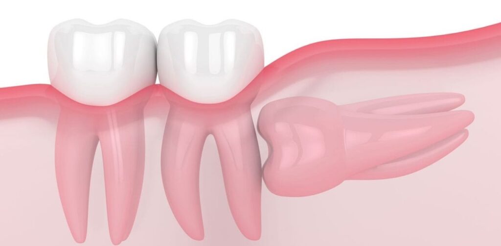 Răng khôn khi mọc ngầm gây đau đớn kéo dài