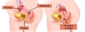 Sa tử cung: Nguyên nhân, biểu hiện và cách điều trị bệnh