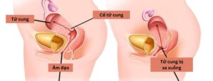 Sa tử cung: Nguyên nhân, biểu hiện và cách điều trị bệnh