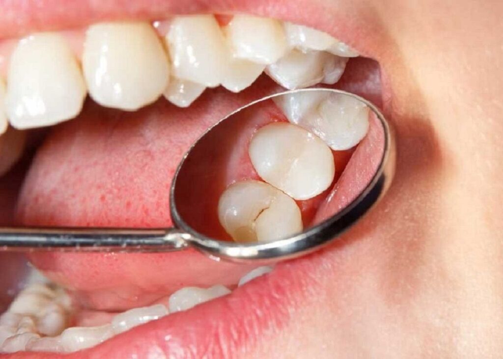 Răng khôn mọc không đúng hướng có thể gây sâu răng 