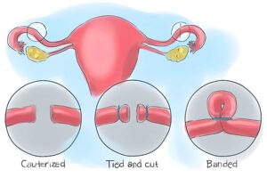 Thắt ống dẫn trứng là gì?