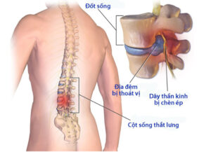 Thoái hóa cột sống là gì?