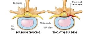 Đĩa đệm bị thoát vị