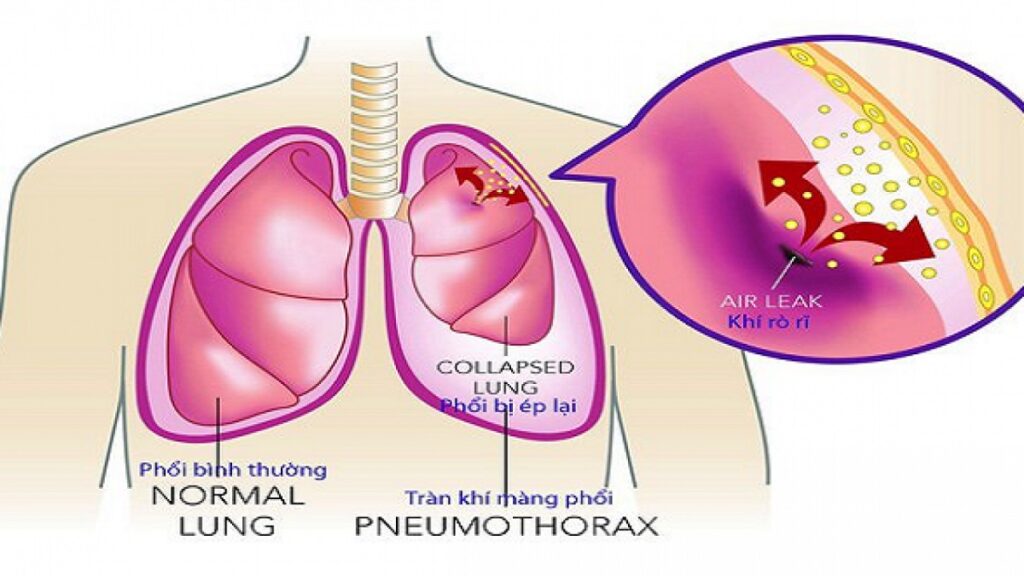 Tràn khí màng phổi gây ra cơn đau ở ngực 