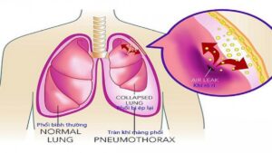 Tràn khí màng phổi gây ra cơn đau ở ngực