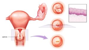 Nếu mắc viêm lộ tuyến cổ tử cung, khí hư ra nhiều, vón cục màu vàng