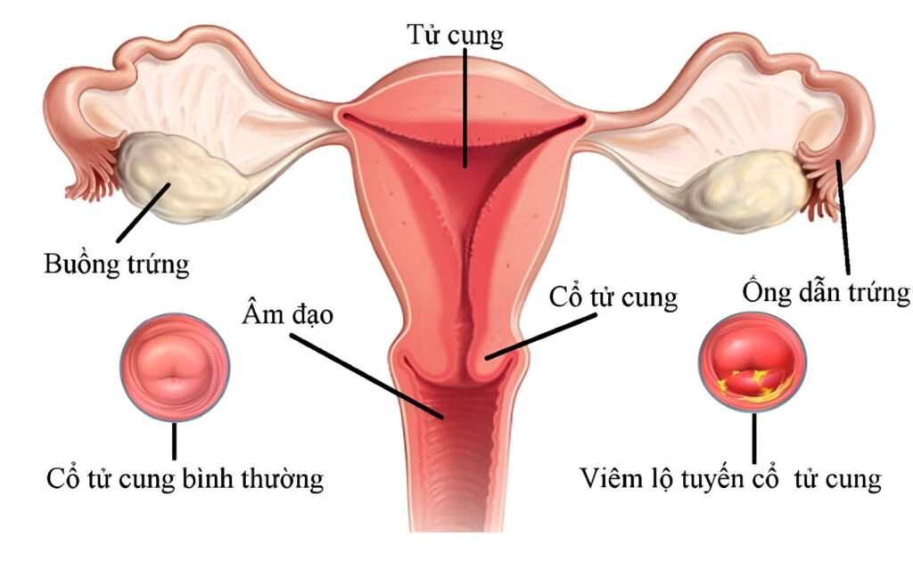 Lộ tuyến tử cung là tình trạng tế bào quyến phát triển và đâm ra ngoài tử cung 