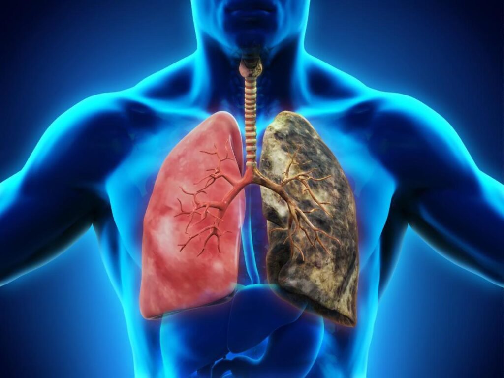 Viêm phổi làm bạn bị đau 