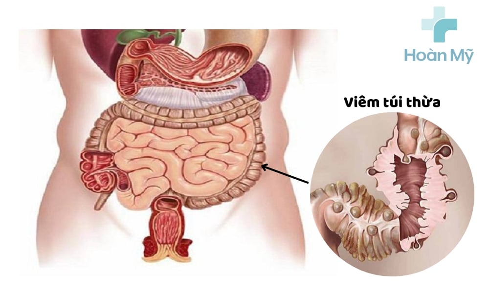 Viêm túi thừa