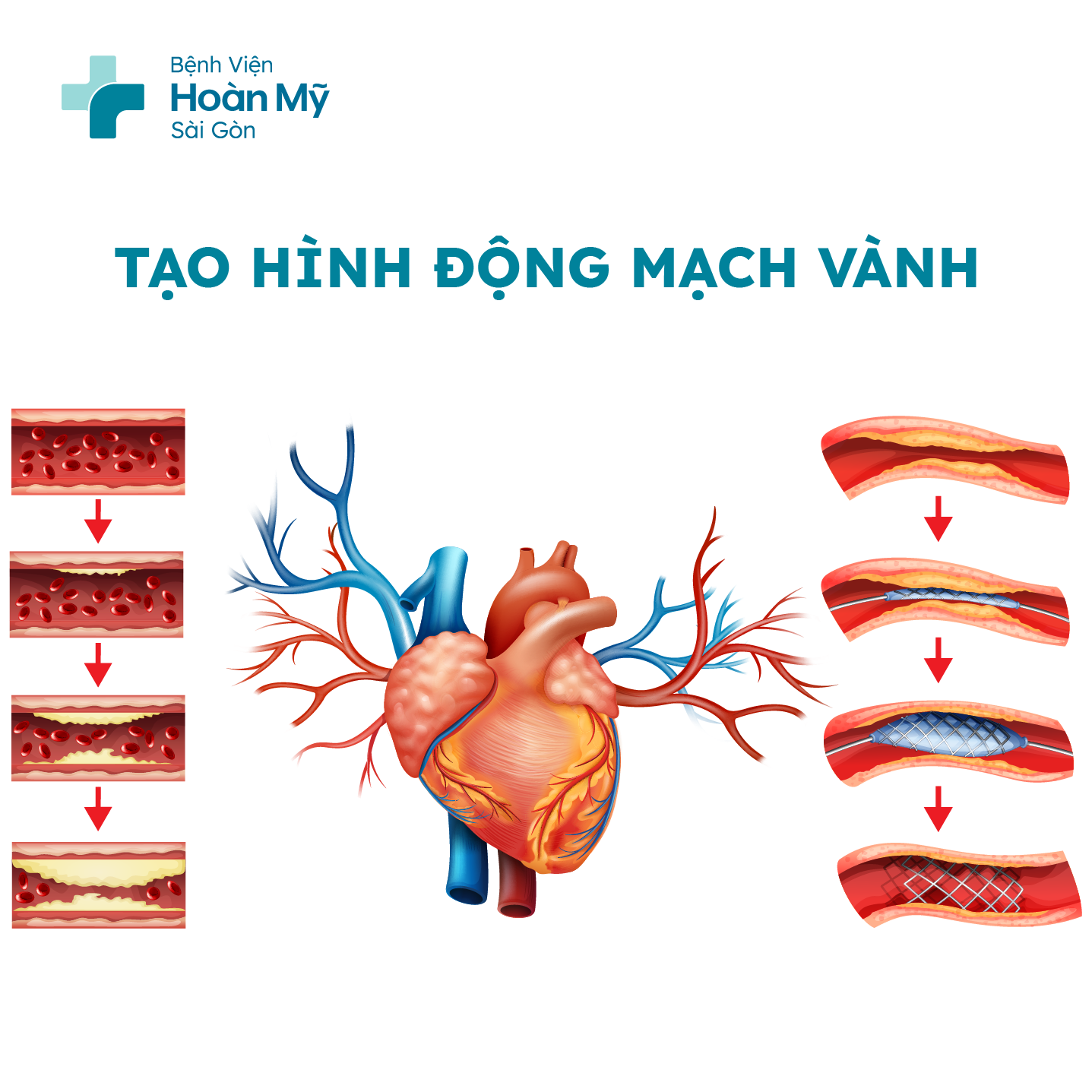 Đặt stent động mạch vành điều giảm xơ vữa, tăng lưu thông máu