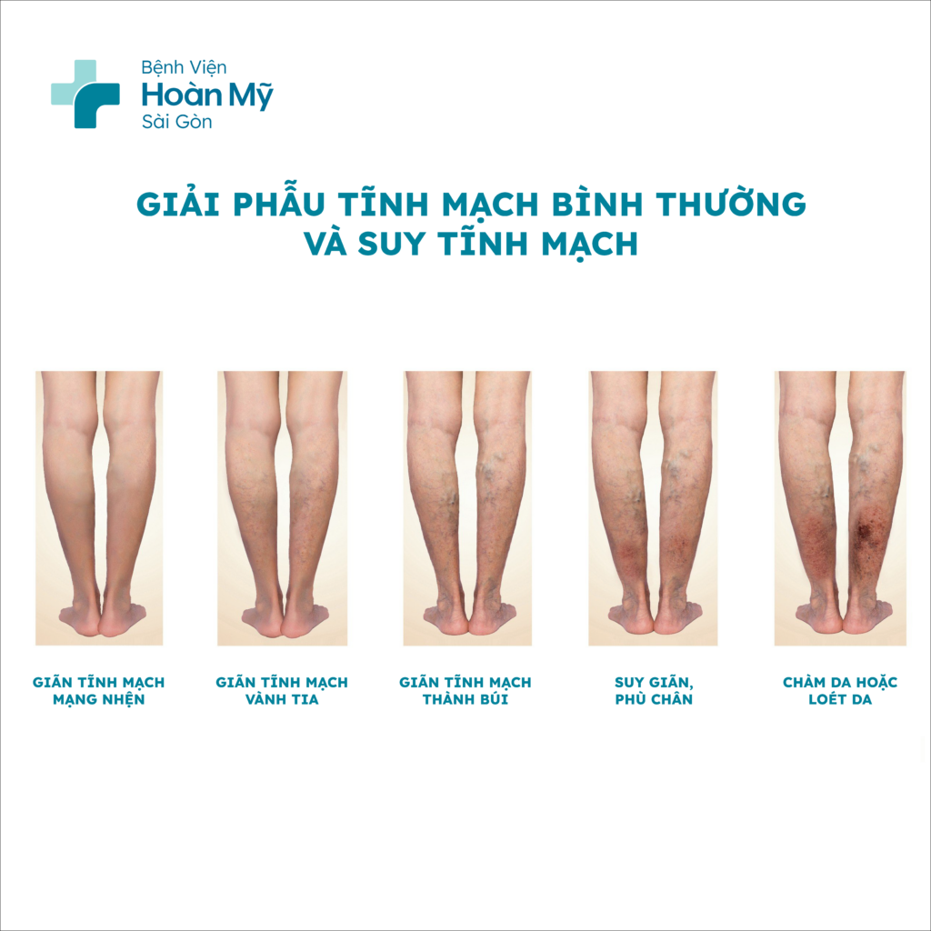 Hình ảnh minh họa sự tiến triển triệu chứng bệnh suy giãn tĩnh mạch chi dưới