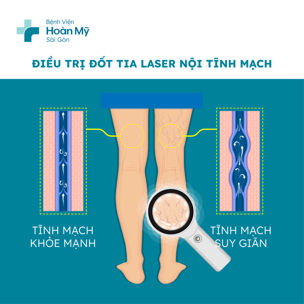 Hình minh họa Laser tĩnh mạch và RFA