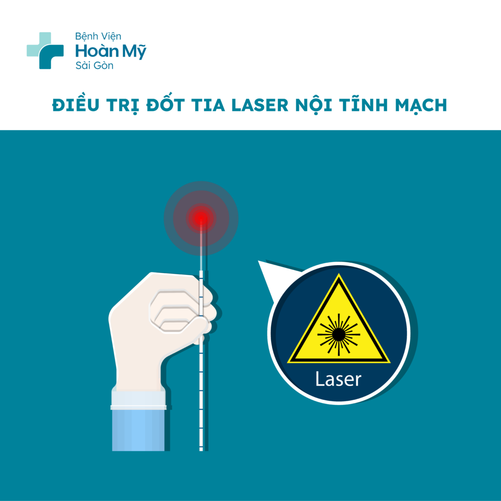 Hình minh họa Laser tĩnh mạch và RFA