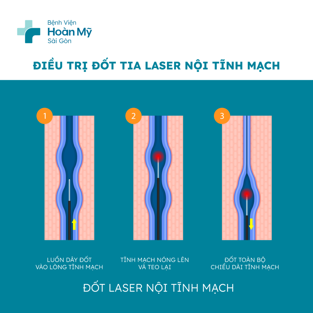 Hình minh họa Laser tĩnh mạch và RFA