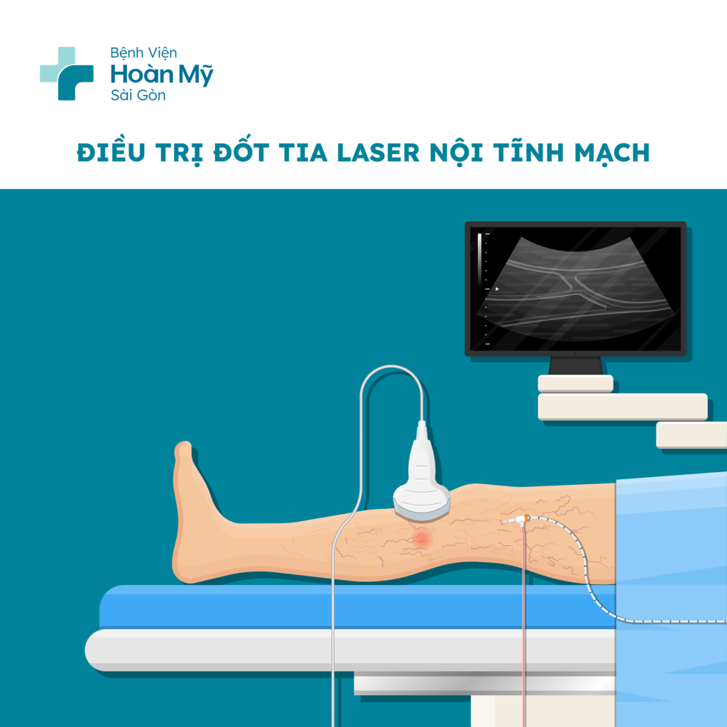 Hình minh họa Laser tĩnh mạch và RFA