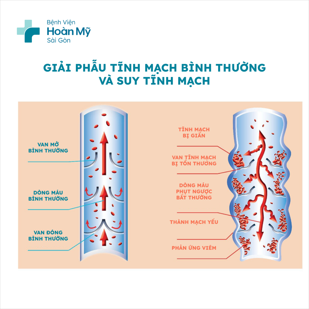 Suy giãn tĩnh mạch là tình trạng suy giảm chức năng đưa máu về tim, gây ứ trệ tại tĩnh mạch chân