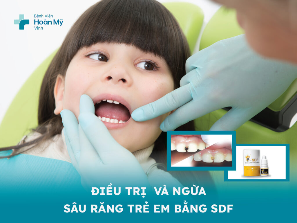Điều trị và ngừa sâu răng trẻ em bằng SDF (Silver Diamine Fluoride)