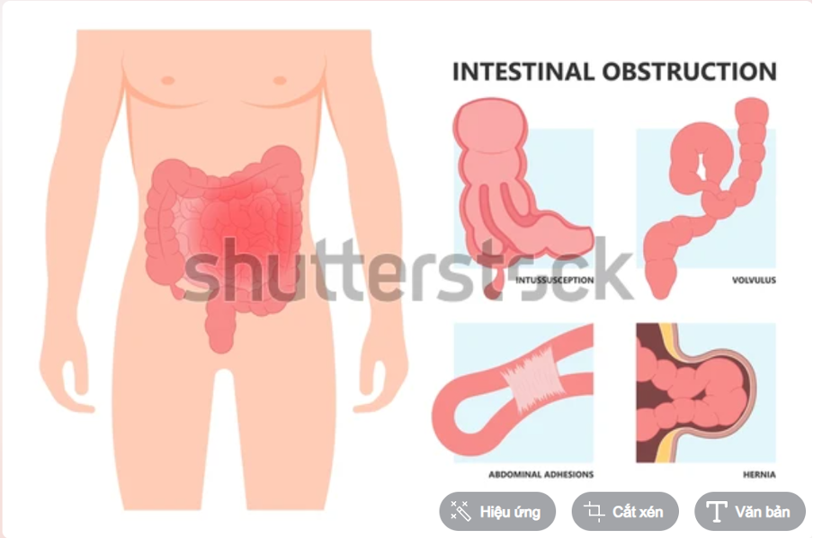 Tắc ruột là tình trạng tắc nghẽn khiến thức ăn hoặc chất lỏng không thể đi qua ruột