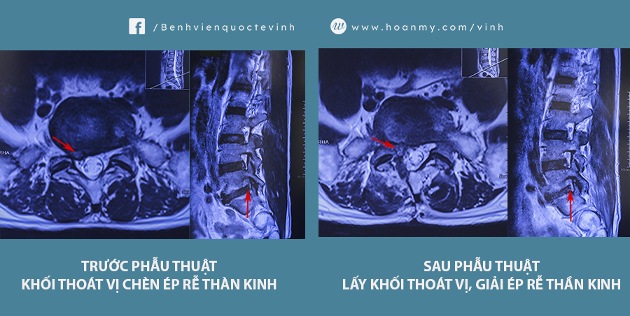 Trước và sau phẫu thuật lấy khối thoát vị chèn ép rễ thần kinh