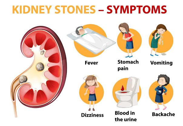 Hình 2: Đau bụng hông dữ dội, buồn nôn, nôn, tiểu máu.. là những triệu chứng thường gặp của bệnh sỏi niệu quản