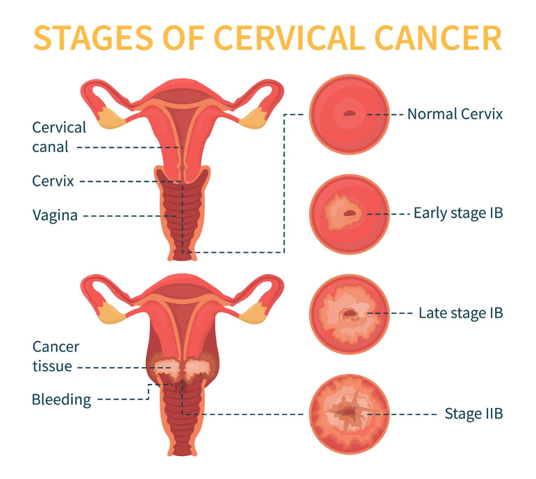 Ung thư cổ cung là tình trạng các tế bào ở cổ tử cung phát triển bất thường tạo thành khối u