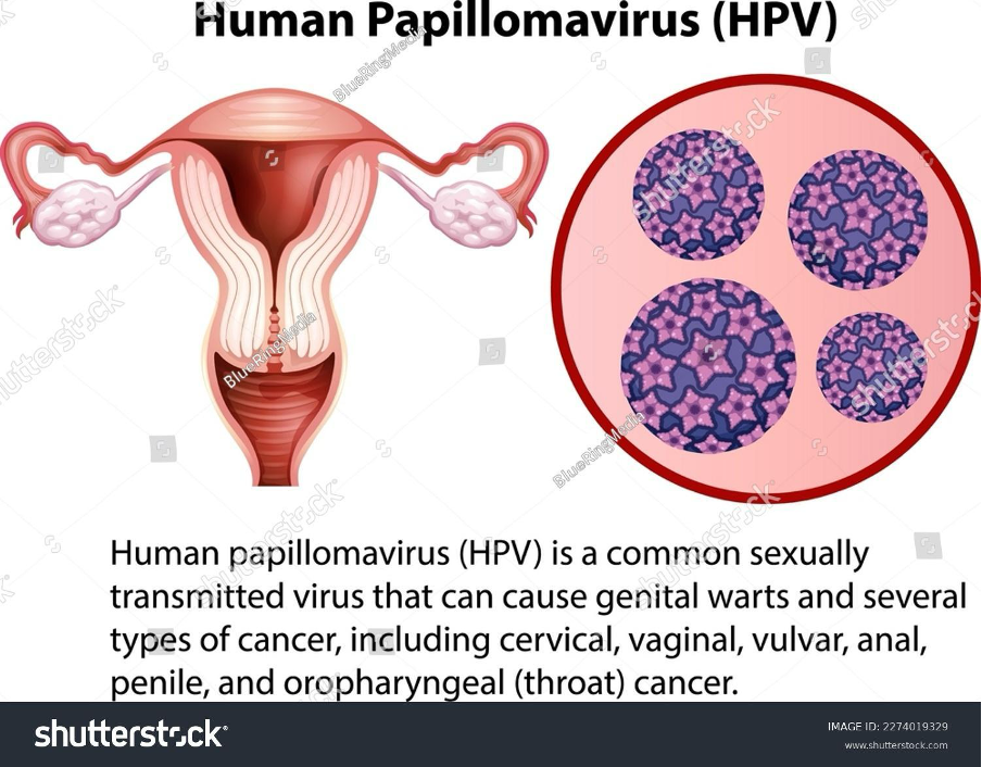Virus HPV - nguyên nhân hàng đầu gây ung thư cổ tử cung