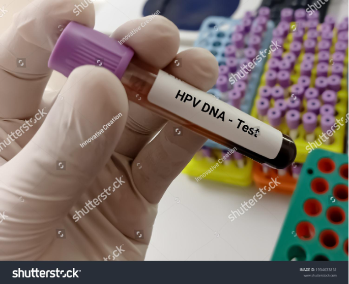 Xét nghiệm HPV Cobas DNA là phương pháp chính xác nhất chẩn đoán ung thư cổ tử cung