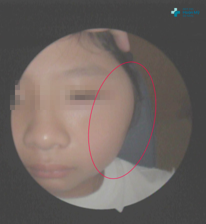 Tình trạng một bên mặt bị sưng to, mưng mủ của người bệnh do biến chứng viêm tai giữa