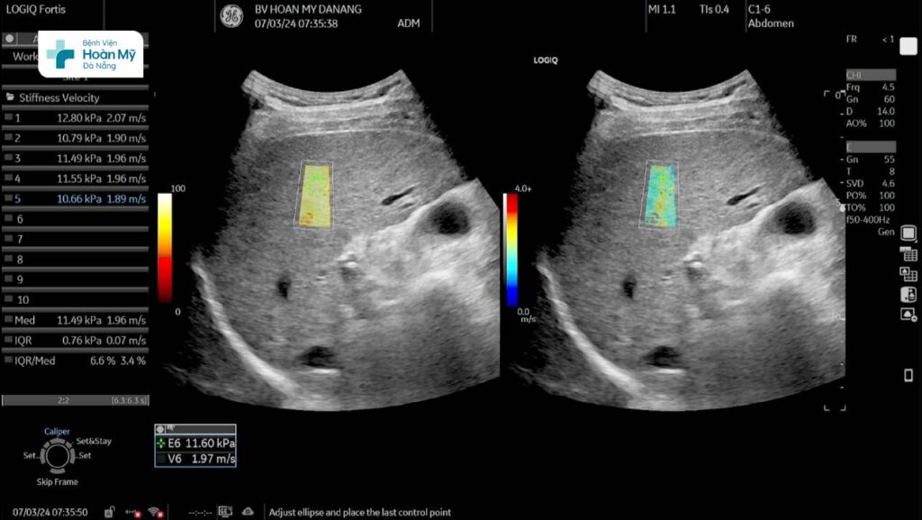 Hình ảnh siêu âm chẩn đoán mức độ xơ hóa gan trên máy siêu âm cao cấp LOGIQ Fortis thế hệ mới tại BV Hoàn Mỹ Đà Nẵng