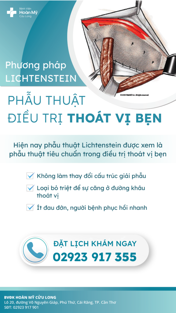 Điều trị thoát vị bẹn bằng phương pháp Lichtenstein