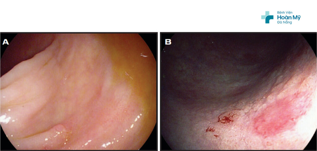 Hình ảnh nội soi chẩn đoán tổn thương dạng phẳng sớm ở đại tràng bằng công nghệ i-SCAN OE trên hệ thống nội soi Pentax EPK – i8020c