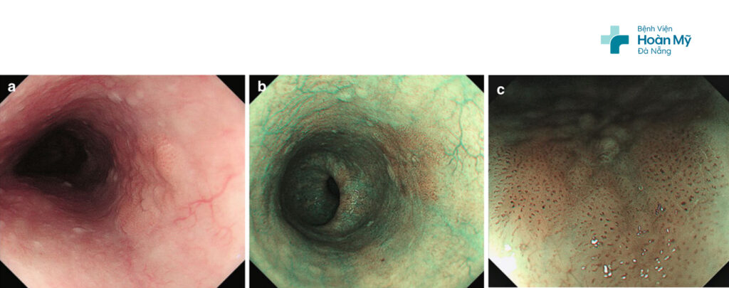 Hình ảnh nội soi chẩn đoán ung thư sớm thực quản bằng công nghệ i-SCAN OE trên hệ thống nội soi Pentax EPK – i8020c