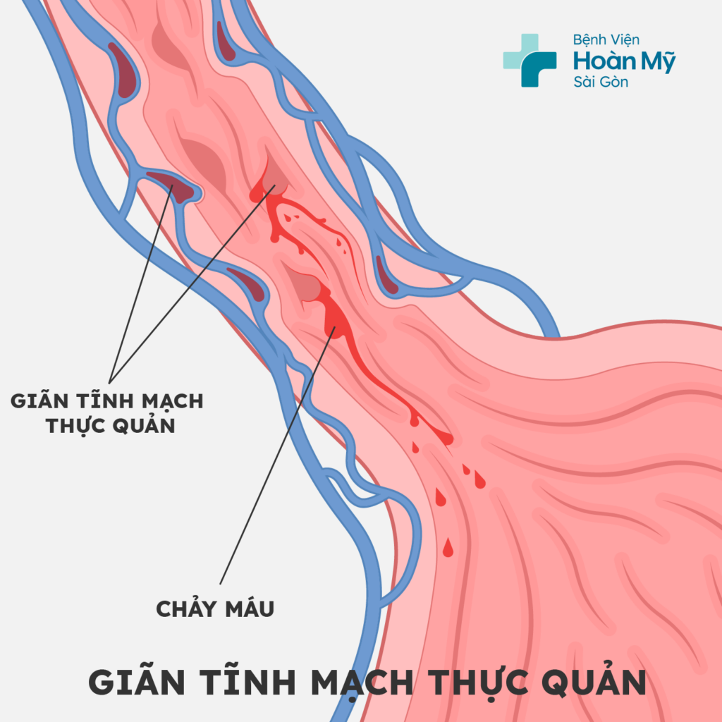 Nội soi thắt các búi giãn tĩnh mạch thực quản ngăn chảy máu