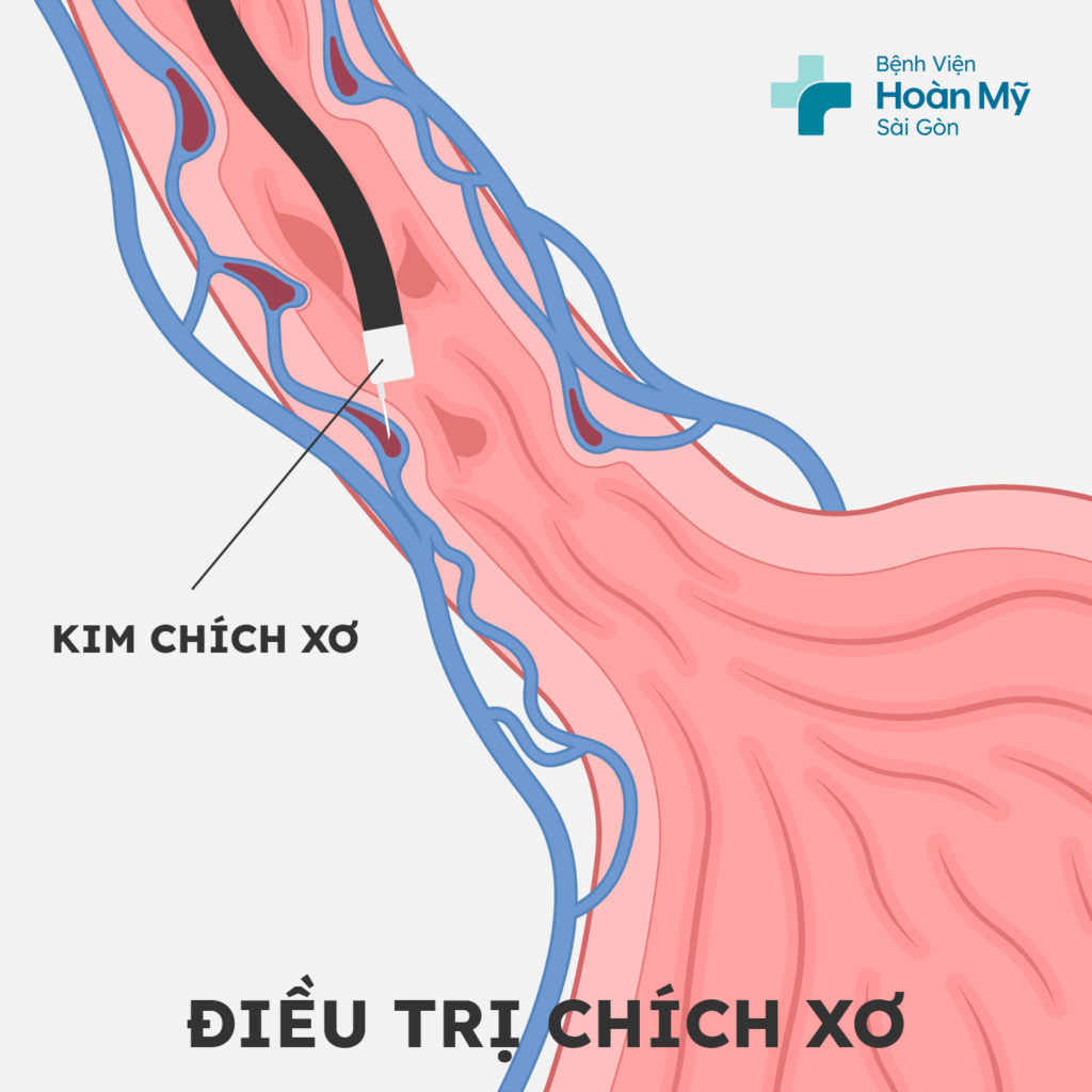 Nội soi thắt các búi giãn tĩnh mạch thực quản ngăn chảy máu