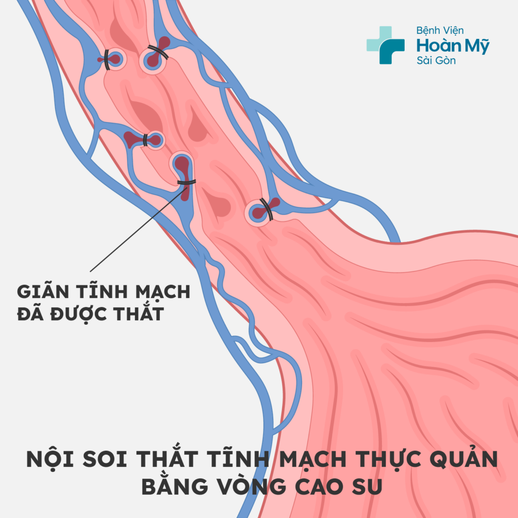 Nội soi thắt các búi giãn tĩnh mạch thực quản ngăn chảy máu