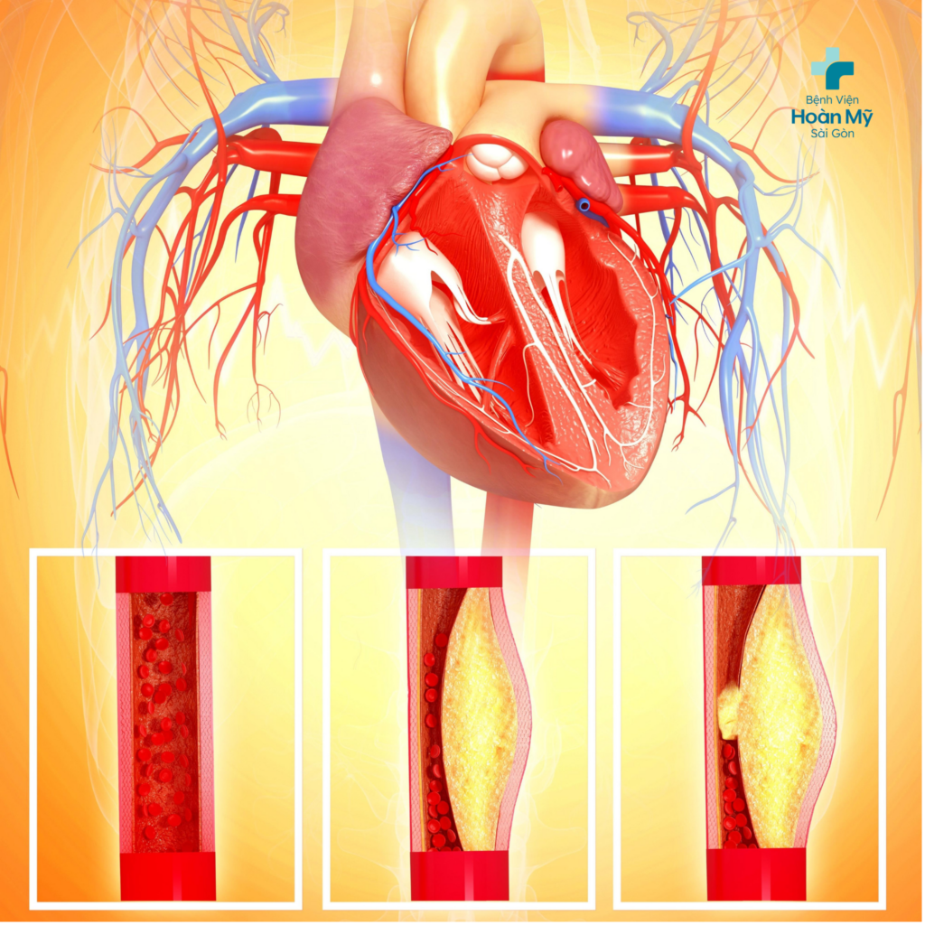 Rối loạn chuyển hóa lipid máu gây nên những mảng xơ vữa động mạch, khiến mạch máu tắc nghẽn