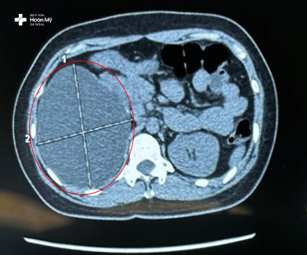 Hình ảnh nang thận lớn quan sát rõ trên hình chụp cắt lớp CT