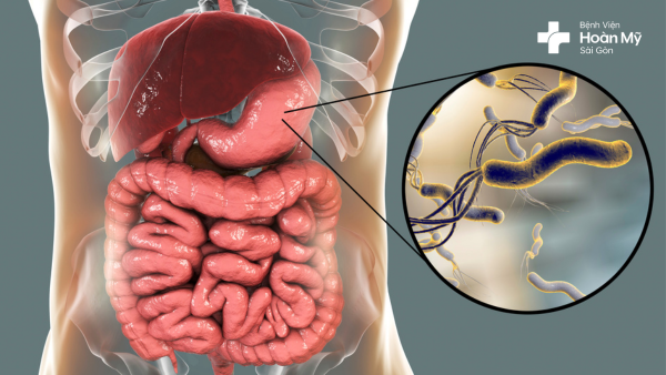 Nhiễm khuẩn Helicobacter pylori là nguyên nhân chính gây loét dạ dày tá tràng