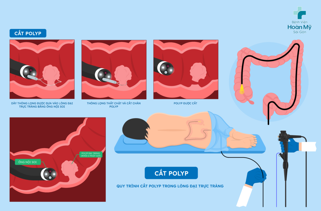 Thông qua nội soi đại trực tràng, các bác sĩ can thiệp cắt bỏ polyp