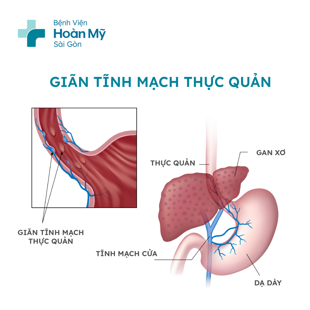 Giãn tĩnh mạch thực quản là tình trạng tĩnh mạch thực quản bị giãn ra, có thể dẫn đến vỡ