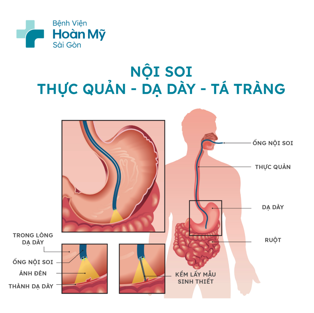 Nội soi tầm soát dạ dày thực quản để phát hiện giãn tĩnh mạch thực quản và các bệnh lý khác