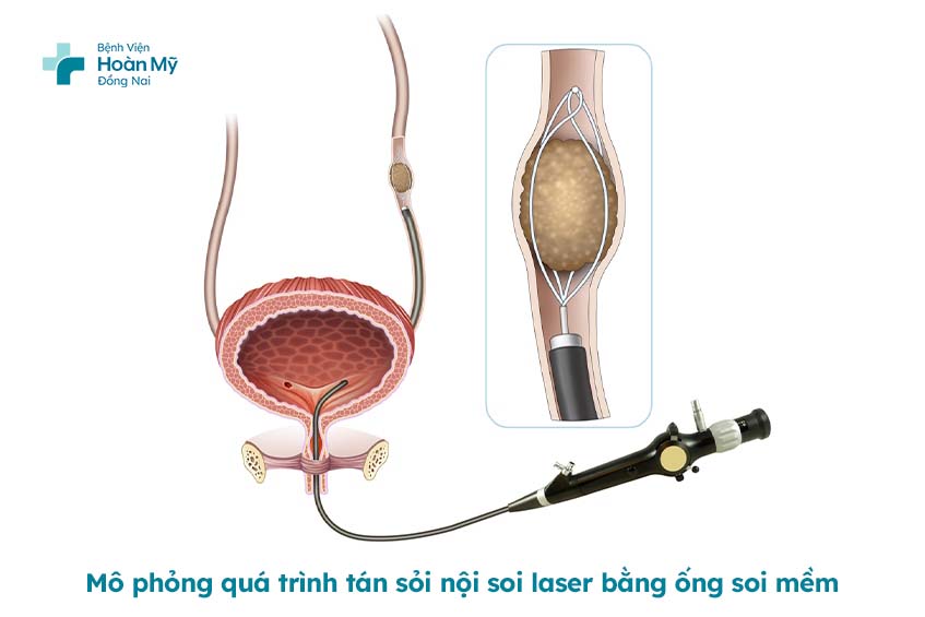 Mô phỏng chi tiết quá trình tán sỏi nội soi laser bằng ống soi mềm tại Bệnh viện Hoàn Mỹ Đồng Nai