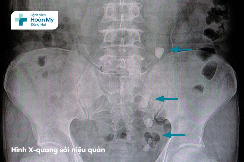 Hình ảnh X-quang của sỏi niệu quản Bệnh viện Hoàn Mỹ Đồng Nai