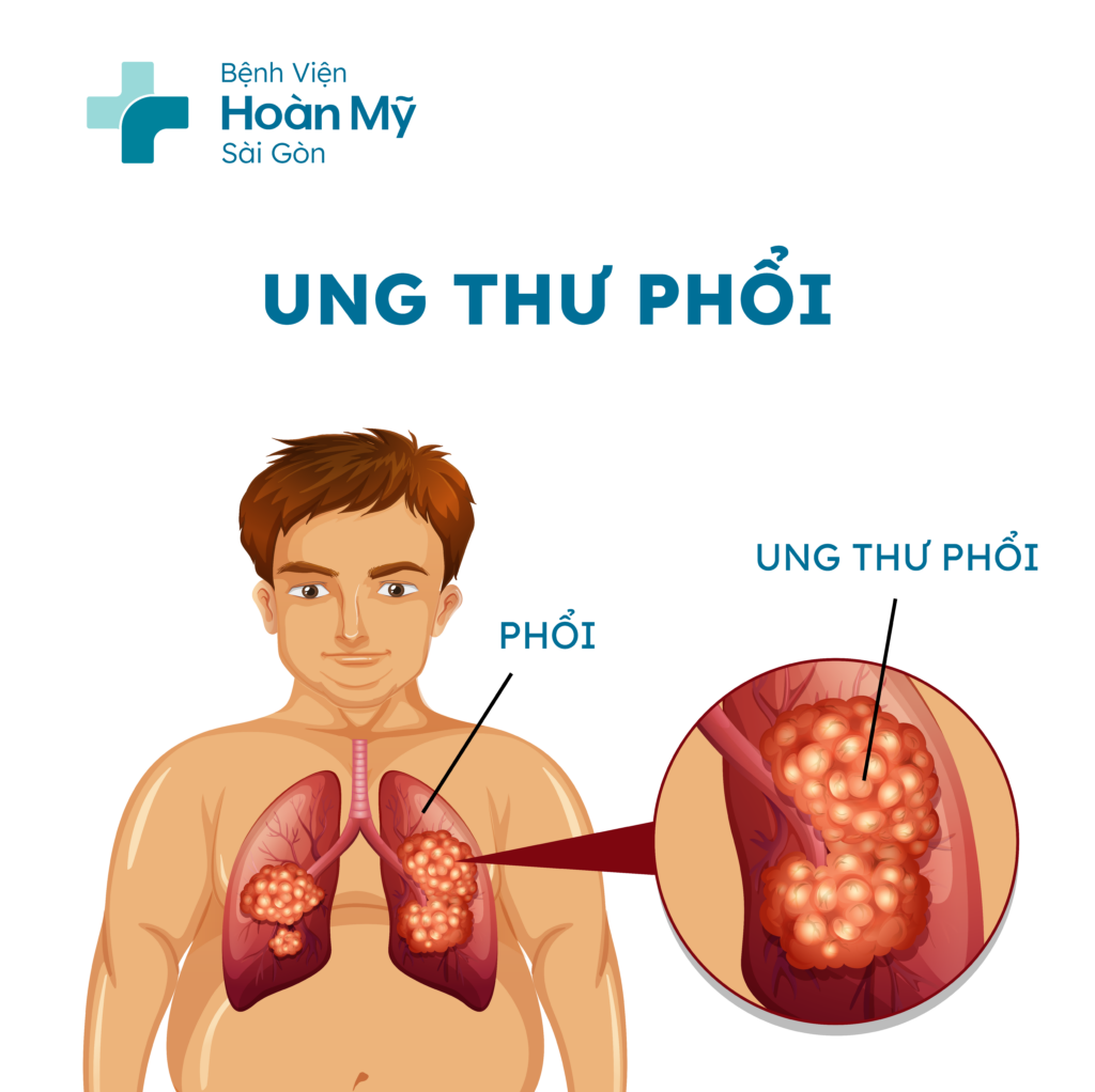 Ung thư phổi là căn bệnh ác tính vô cùng nguy hiểm với tỷ lệ tử vong cao