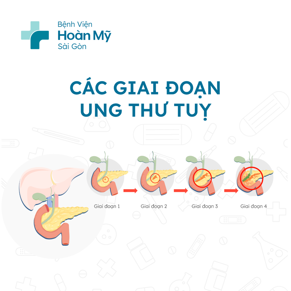 Các giai đoạn ung thư tuỵ