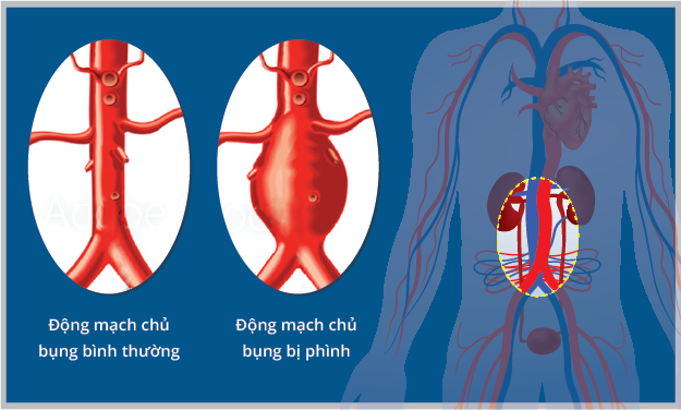 Phình động mạch chủ