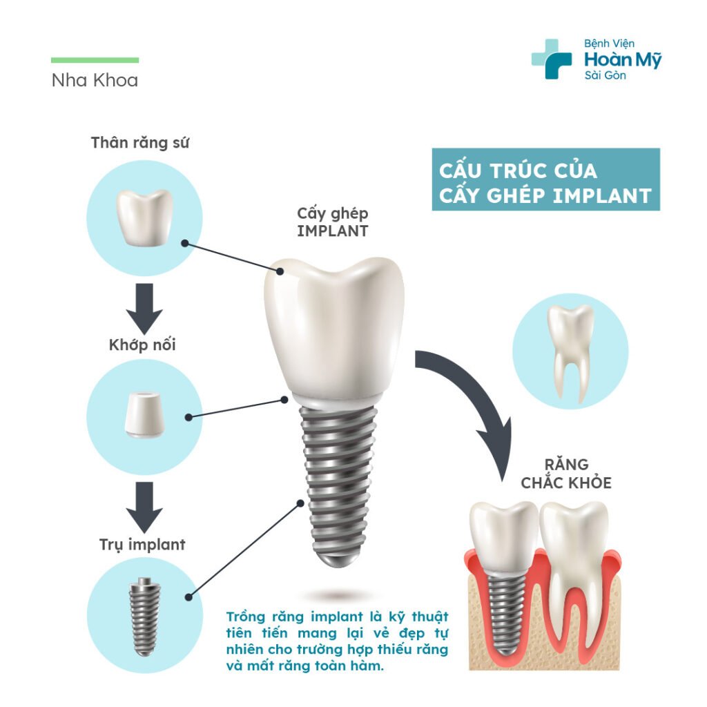 Lợi ích của việc trồng implant