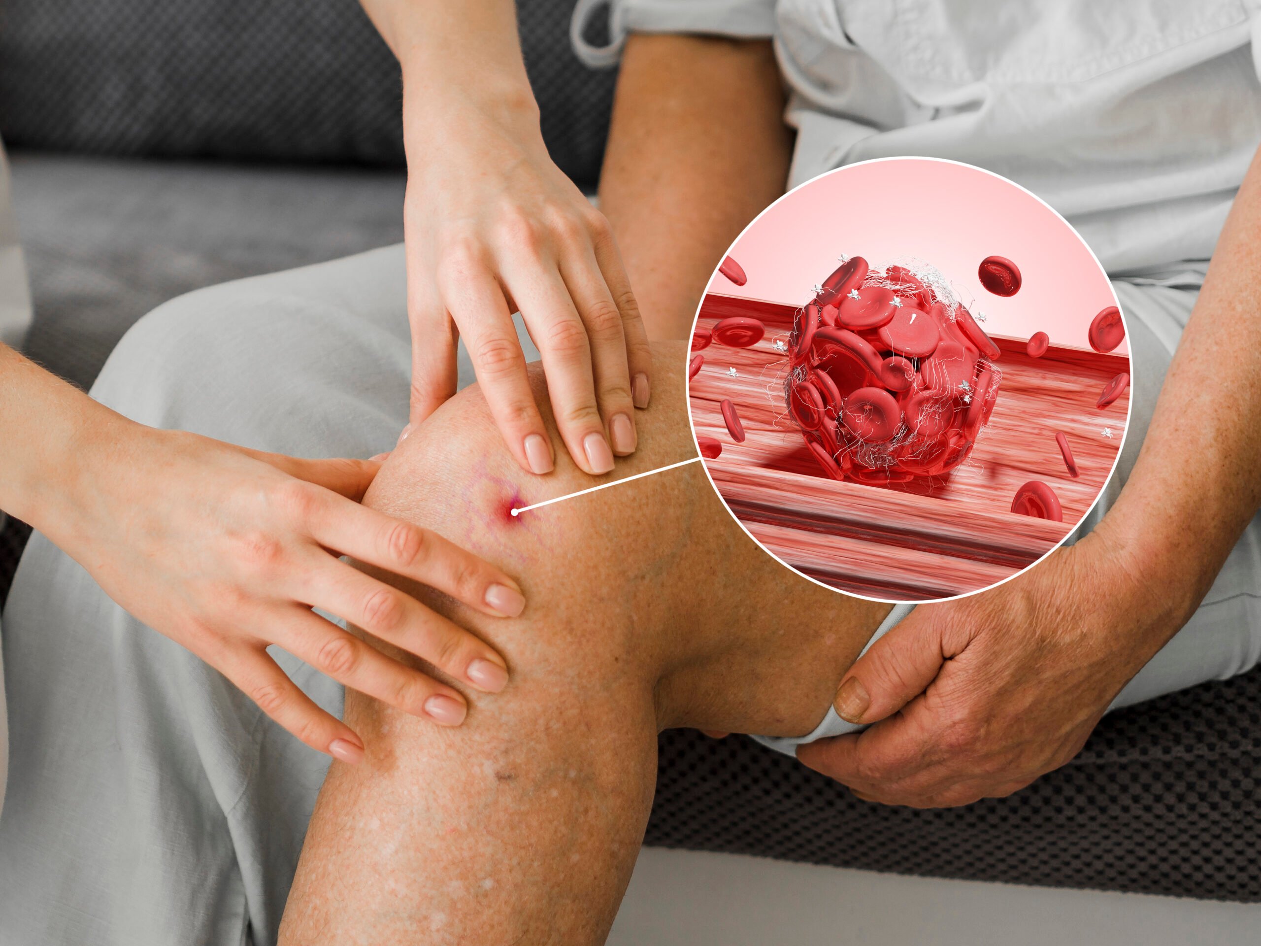 THUYÊN TẮC HUYẾT KHỐI TĨNH MẠCH 